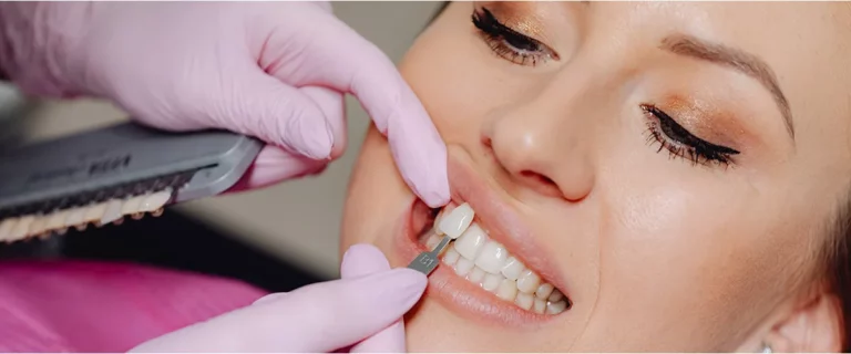 veneers-cover